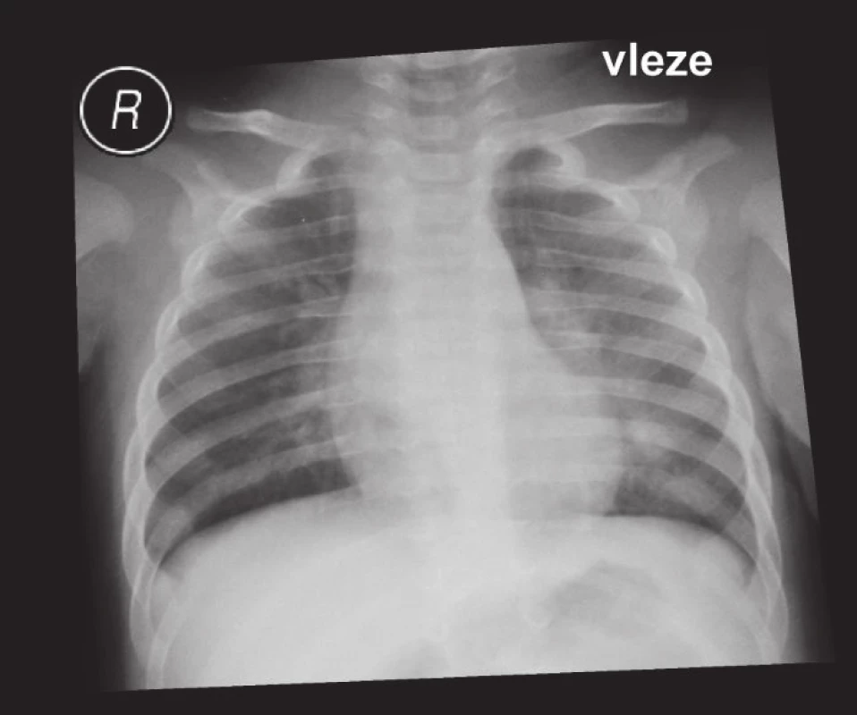 Spalničky – bronchopneumonie.
Fig. 2. Measles – pneumonia.