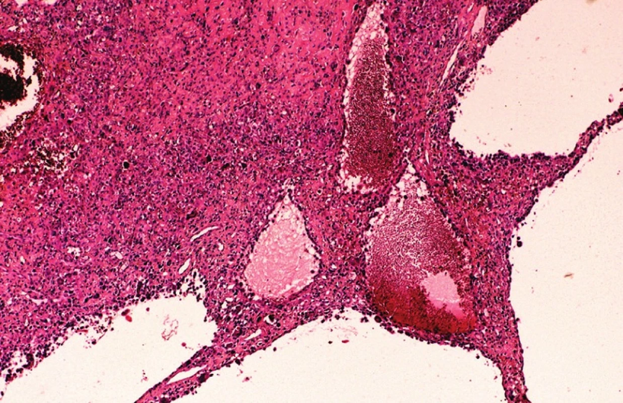 Přehledný snímek teleangiektatického osteosarkomu. V septech se nacházejí osteoklasty a atypické nádorové buňky s osteoplazií. HE, x40.