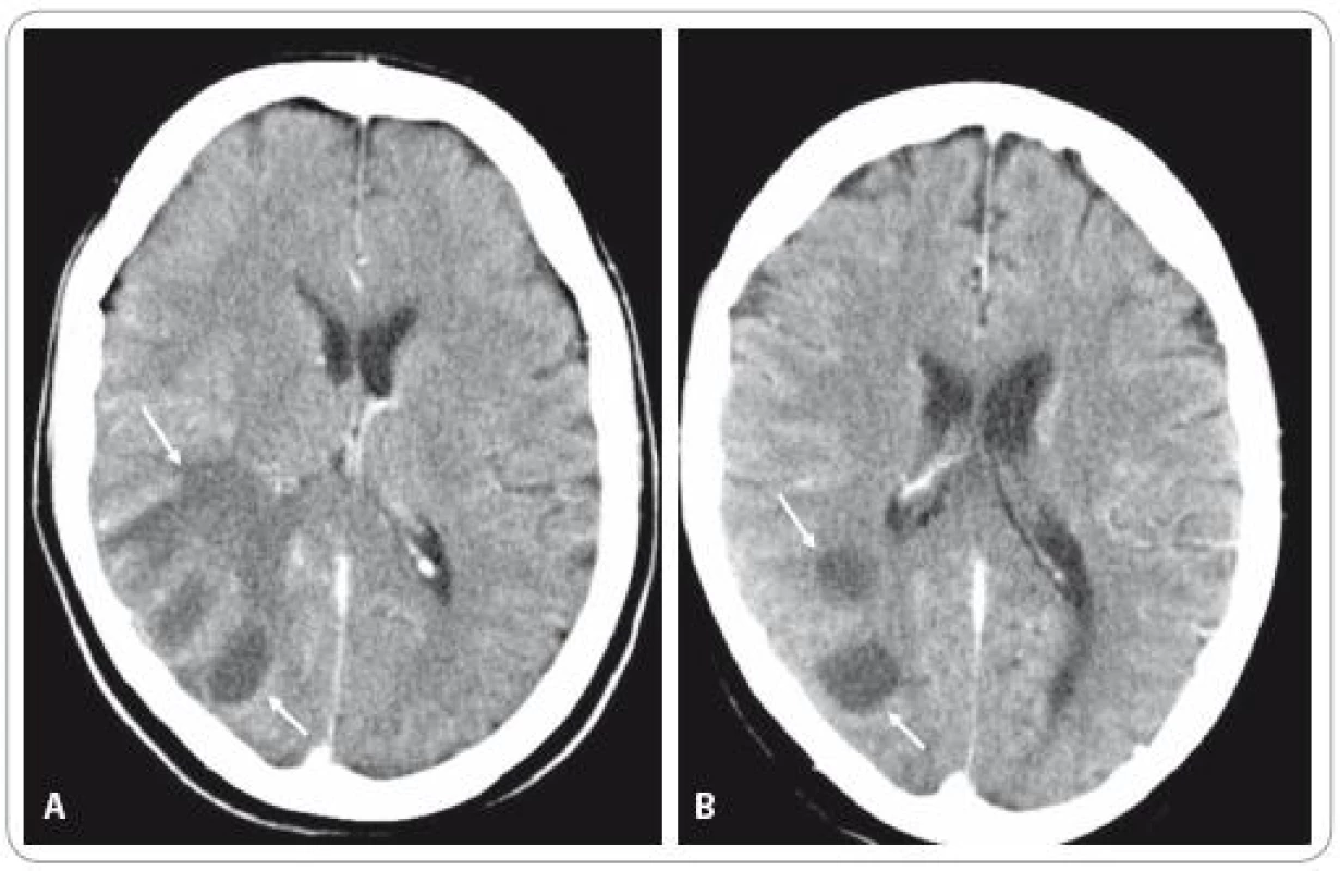 CT mozku s intravenózním kontrastem prokazující rozsáhlý cystoidní nádor parieto-okcipitálně vpravo (šipky). Stav před radioterapii 30 Gy na kranium (A) a po ní (B).