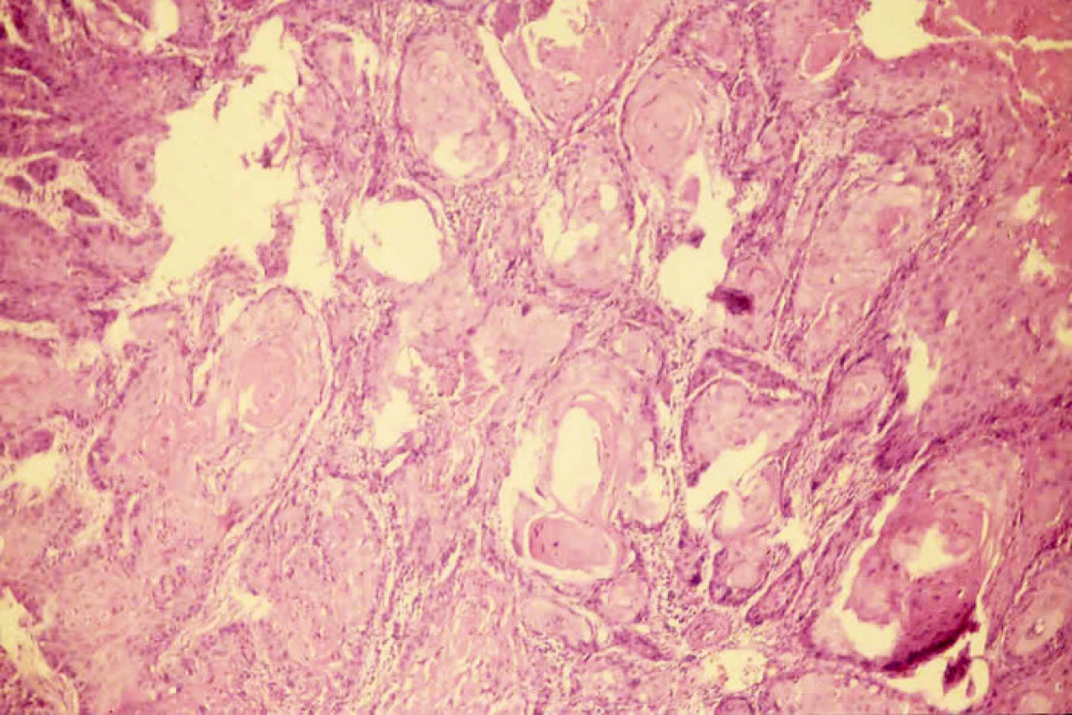 Struktury dobře diferencovaného rohovějícího spino celulárního karcinomu. Hematoxylin-eozin, zvětšení l00x
Fig. 2. Structures of a well- differentiated, keratinizing spinocellular carcinoma. Hematoxylin-eosin, enlargement 100x
