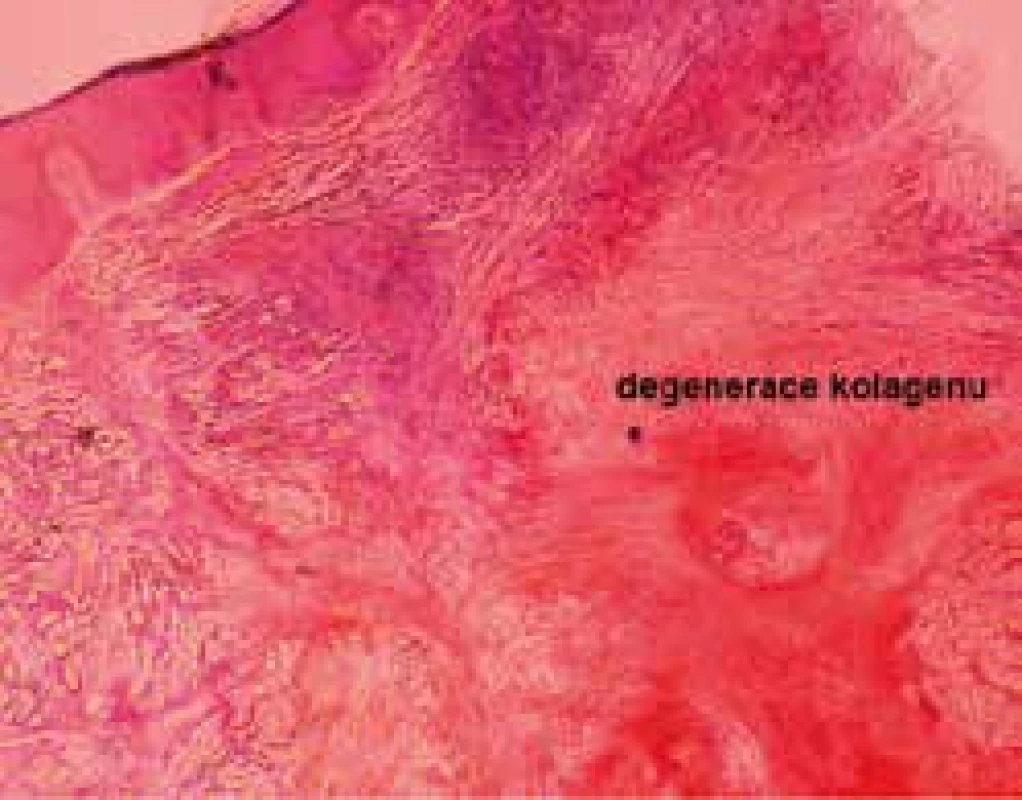 Histologie necrobiosis lipoidica, přehledný snímek (barvení hematoxylinem a eozinem)