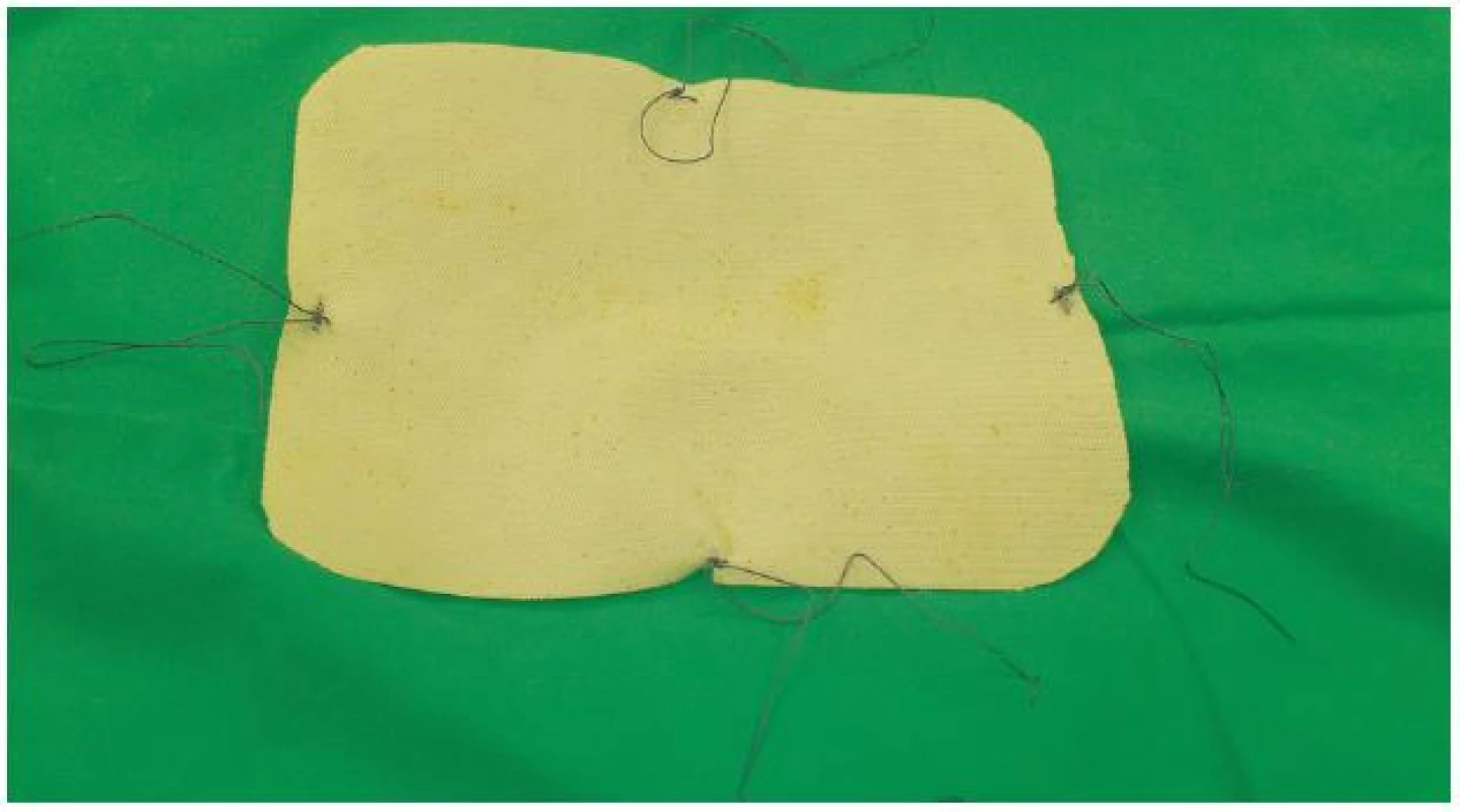 Naložené transabdominálne Vicrylové fixačné stehy
Fig. 2: Transabdominal Vicryl fixating stitches