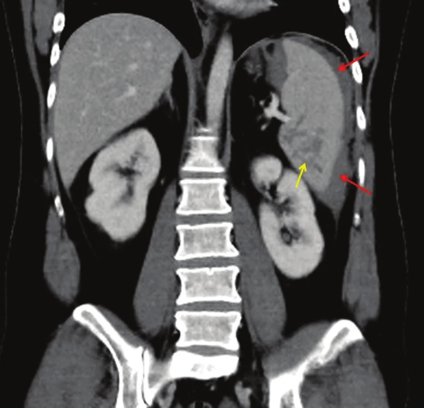 CT vyšetření břicha postkontrastně, v portovenózní fázi, koronární rovina. Vícečetné hypodenzní linie parenchymu sleziny odpovídající laceracím ( žlutá šipka), subkapsulární hematom (červené šipky).