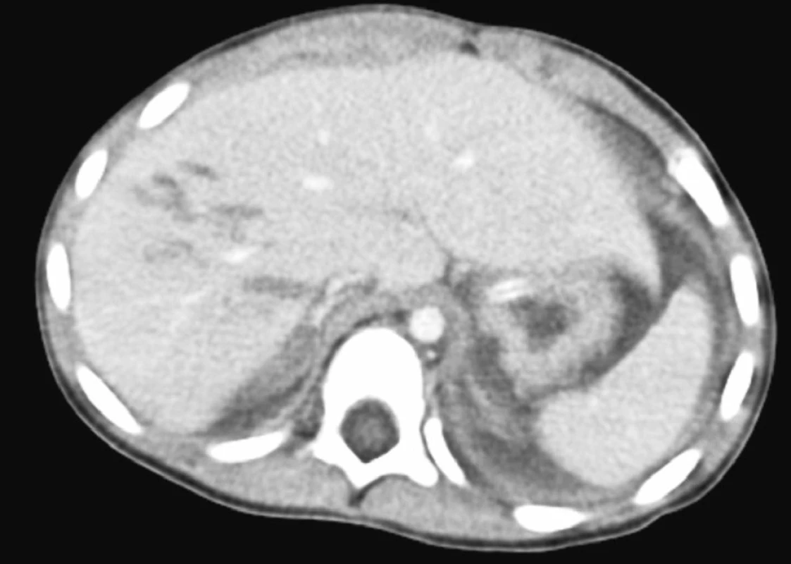 CT obraz kontuze jater
Fig. 4. CT view of liver contusion