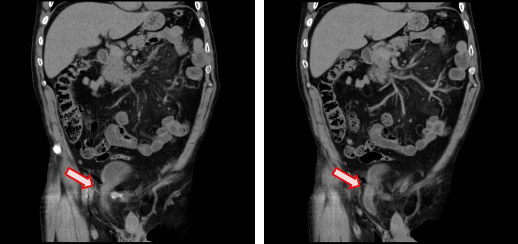 CT koronární řez – herniace močového měchýře do pravého třísla (velikost 48x28 mm)
Fig. 1. CT coronal plane – inguinal bladder herniation (size 48x28 mm)