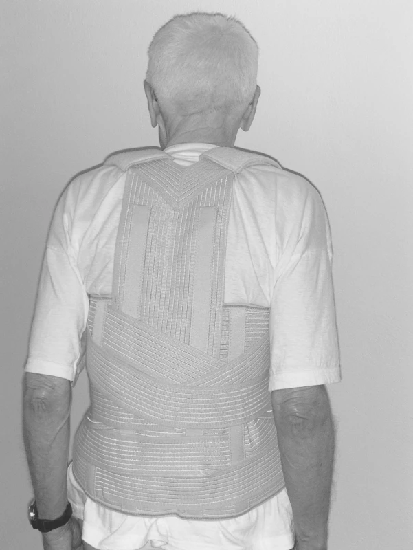 Pacient JŠ – korzet s fixací přes ramena.