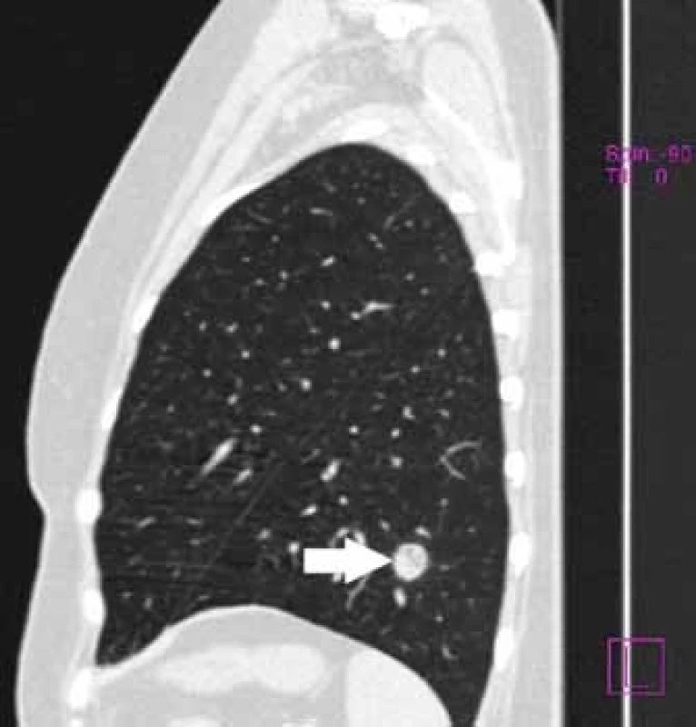 Bílá šipka – 15mm tumor v oblasti levé plíce.
Fig. 2. White arrow – 15mm tumour in left lung lobe.