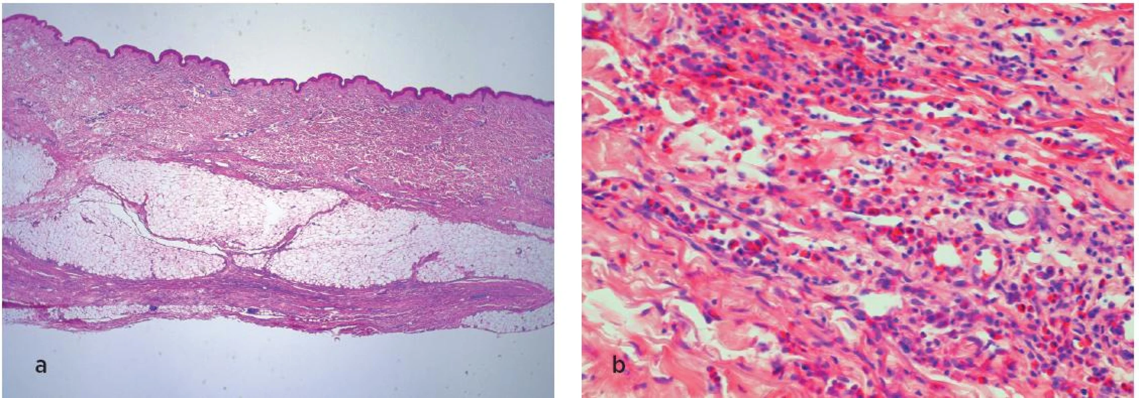 Histologické vyšetření kůže, podkoží a svalů. V přehledném obraze (a) je patrná atrofická epidermis, rozšířené fibrotizované korium s lymfocytárními zánětlivými infiltráty. V detailu (b) je patrná i příměs eozinofilů v infiltrátech.