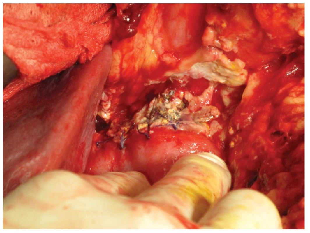 Kazuistika 2 – okrajová nekróza pankreatu v dehiscentní PJA
Fig. 5: Case 2 – PJA leakage – marginal pancreas necrosis