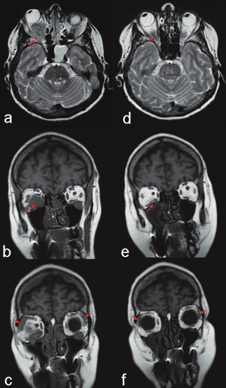 MR vyšetření (T2 tra a T1 cor): Před startem terapie objemný infiltrát oboustranně v n. maxillaris, vpravo podél m. rectus inferior a lateralis a pravostranný exoftalmus (část a, b - šipky); oboustranně, ale více vpravo, zbytnělá slzná žláza (část c, šipky). Kontrola za tři měsíce: minimální reziduum infiltrátu při m. rectus inferior, výrazný ústup exoftalmu (část d,  e - šipky) a velikosti obou slzných žláz (část f, šipky). Pravá strana je z pohledu vyšetřované osoby jako na obrázku 2.