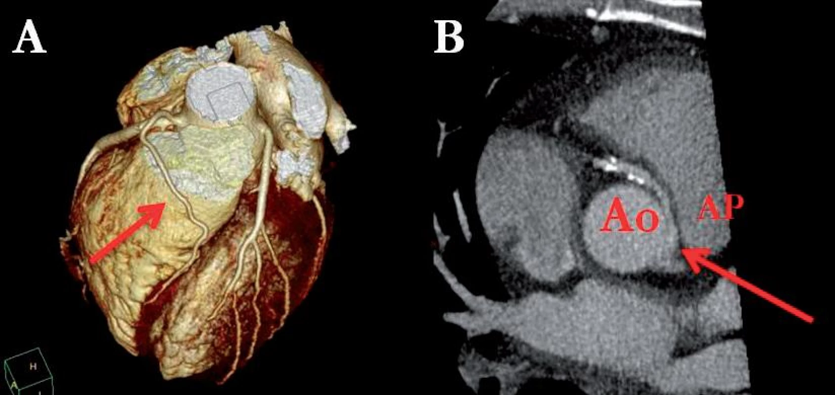 Pacient s anomálním odstupem RIA z proximálního úseku pravé koronární tepny (ACD), jedná se o „benigní“ prepulmonální průběh (A). Pacient s anomálním odstupem ACD z levého koronárního sinu a následným „maligním“ průběhem mezi kmenem plicnice a ascendentní aortou (B). Tato anomálie je spojena s vyšším rizikem náhle smrti.