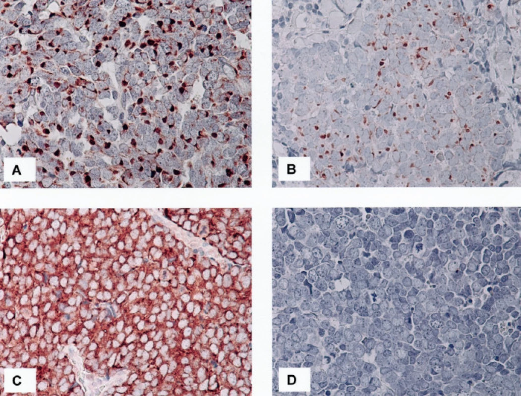 2A. Čepičkovitá pozitivita MNF 116 v cytoplazmě nádorových buněk v jedné ze dvou vyšetřených lokálních recidiv karcinomu z Merkelových buněk, 400krát
2B. Ložisko čepičkovité pozitivity cytokeratinu 7 v cytoplazmě nádorových buněk v jednom z vyšetřených karcinomů, 400krát
2C, D. Detekce beta tubulinu třídy III. Pomocí protilátky TU-20 je zastižena intenzivní difuzní pozitivita v cytoplazmě nádorových buněk (C), imunodetekce pomocí protilátky TuJ-1 je negativní (D), 400krát (C, D)