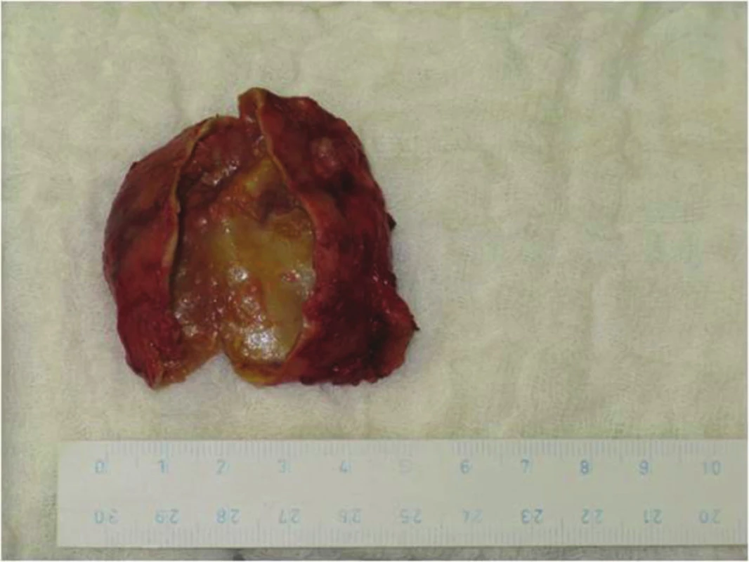 Rozstřižený preparát příštítného adenomu
Fig. 5: Cut preparation of the parathyroid adenoma