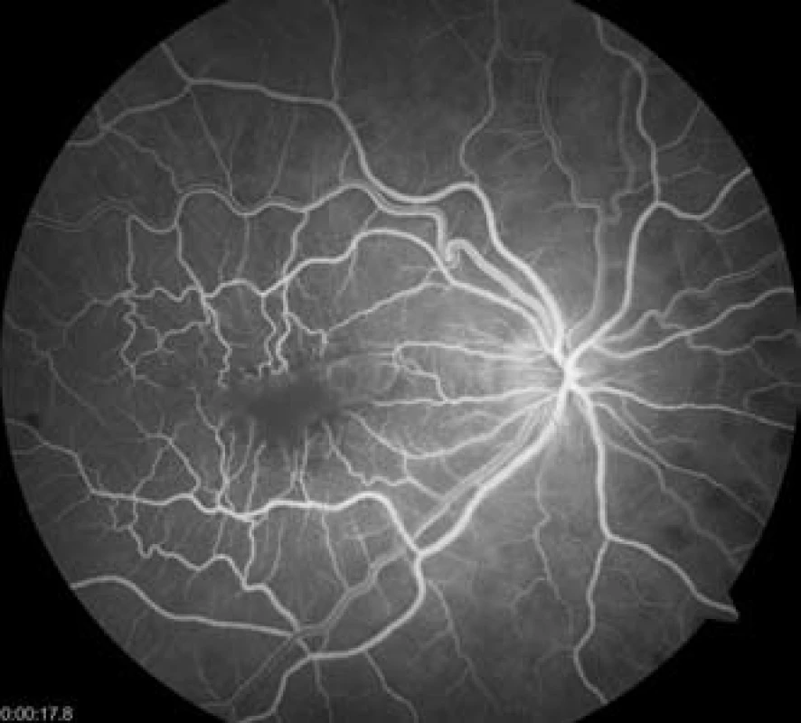 Fluorescenční angiogram v 18. sekundě, retinální řečiště se plní bez defektu, chorioidea rovněž bez výpadku průtoku