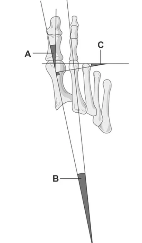 Hodnocení úhlu I. paprsku nohy.
Legenda:
A – úhel valgozity palce, B – intermetatarzální úhel, C – úhel mezi osou diafýzy a hlavičky I. metatarzu (DMAA) (upraveno podle Robinsona, Limberse, 2005)
