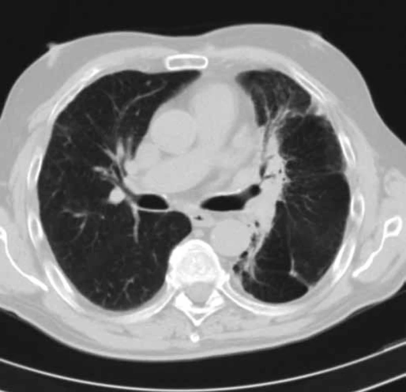 CT hrudníku pacienta č. 2 v době probíhající léčby erlotinibem (duben 2013).
Obrázek zobrazuje částečné zmenšení velikosti tumoru levé plíce a téměř úplné vymizení dys-/atelektatických změn dolního laloku levé plíce. Efekt léčby erlotinibem – parciální regrese.