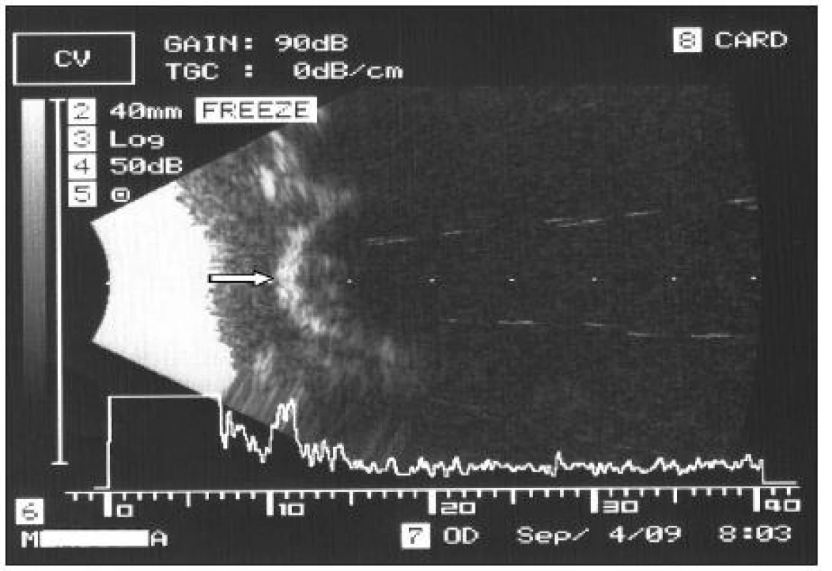 Ultrazvukový obraz v B systéme (šípka ukazuje na predný povrch implantátu)