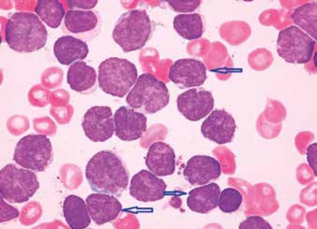 MCL, klasická morfologie (převažují centrocyty – malé či středně velké lymfocyty s vysokým nukleocytoplazmatickým poměrem, méně kondenzovaným jaderným chromatinem a četnými jadernými atypiemi, „buttock cells“ jsou označeny šipkami)
