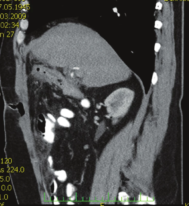 CT vyšetření břicha s nálezem defektu v břišní stěně se vzduchem
Fig. 2. Abdominal CT examination showing an abdominal wall defect with air