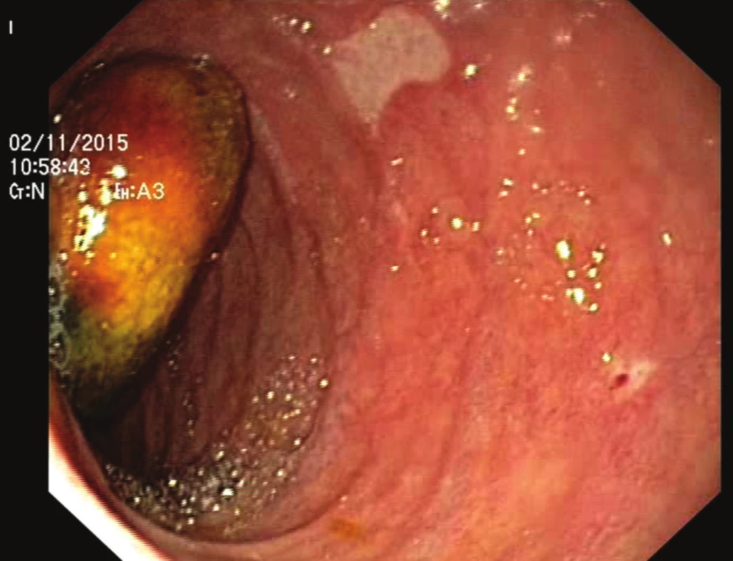 Endoskopie s nálezem žlučového kamene v sestupné části duodena
Fig. 2: Endoscopy confirming the presence of a gallstone in the descending part of the duodenum