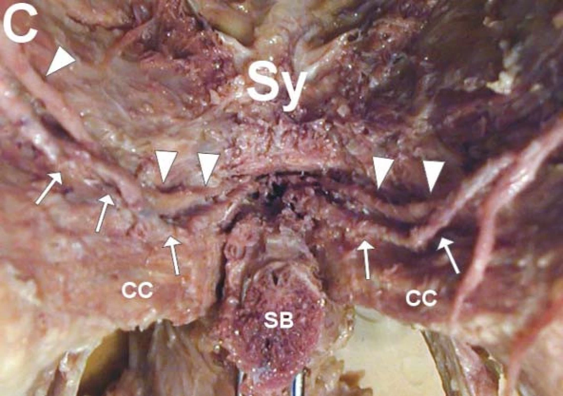 Nervus dorsalis penis (►) a arteria dorsalis penis (→) při pohledu zdola. CC - crus corporis cavernosi, SB - corpus spongiosum, Sy - symfýza.