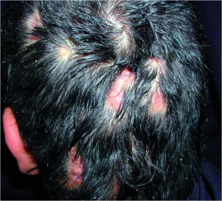 Pseudopelade – jizvící alopecie, alopecia cicatrisata