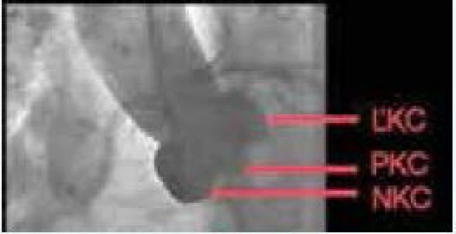 Ideálna implantačná skiaskopická kolmá projekcia na bazálny prstenec aortálnej chlopne. Zdroj: VÚSCH a.s.