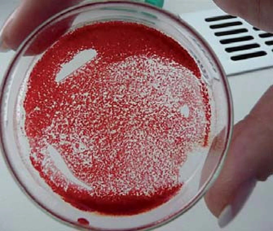Krev našeho pacienta vystříknutá na Petriho misku. Po rozetření krve po misce okamžitě vzniká zřetelná aglutinace erytrocytů, podobně, jako když při křížovém pokusu přidáme  k vzorku krve odpovídající diagnostické protilátky.