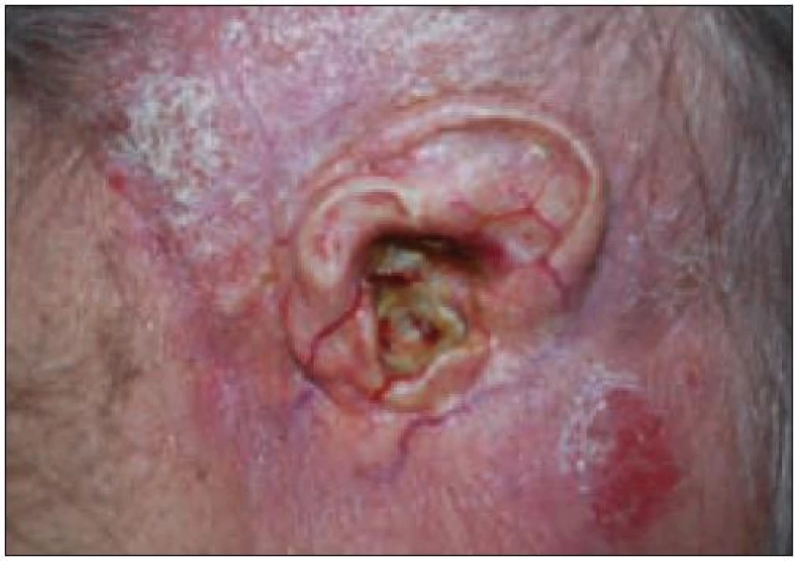 Trofické kožní změny v oblasti pravého ušního boltce, slepě uzavřený zvukovod, seborrhoická dermatitida ve vlasaté části hlavy u pacientky 1.