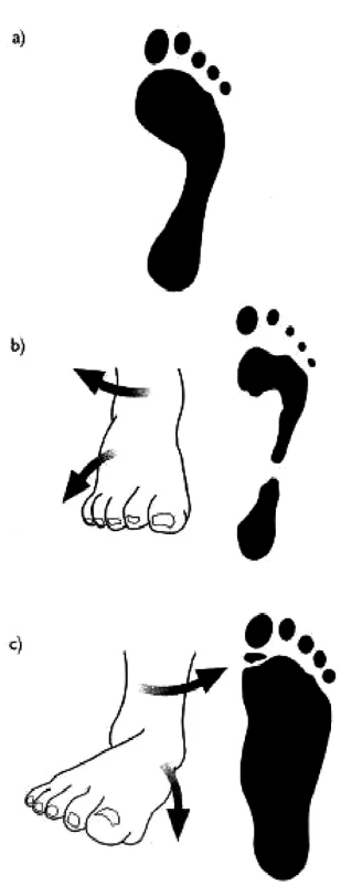 a) normální noha
b) nadmûrná supinace
c) nadmûrná pronace