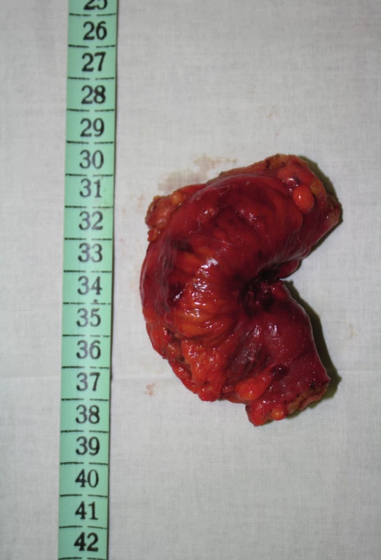 Resekát colon sigmoideum
Fig. 2: Excised part of the colon sigmoideum