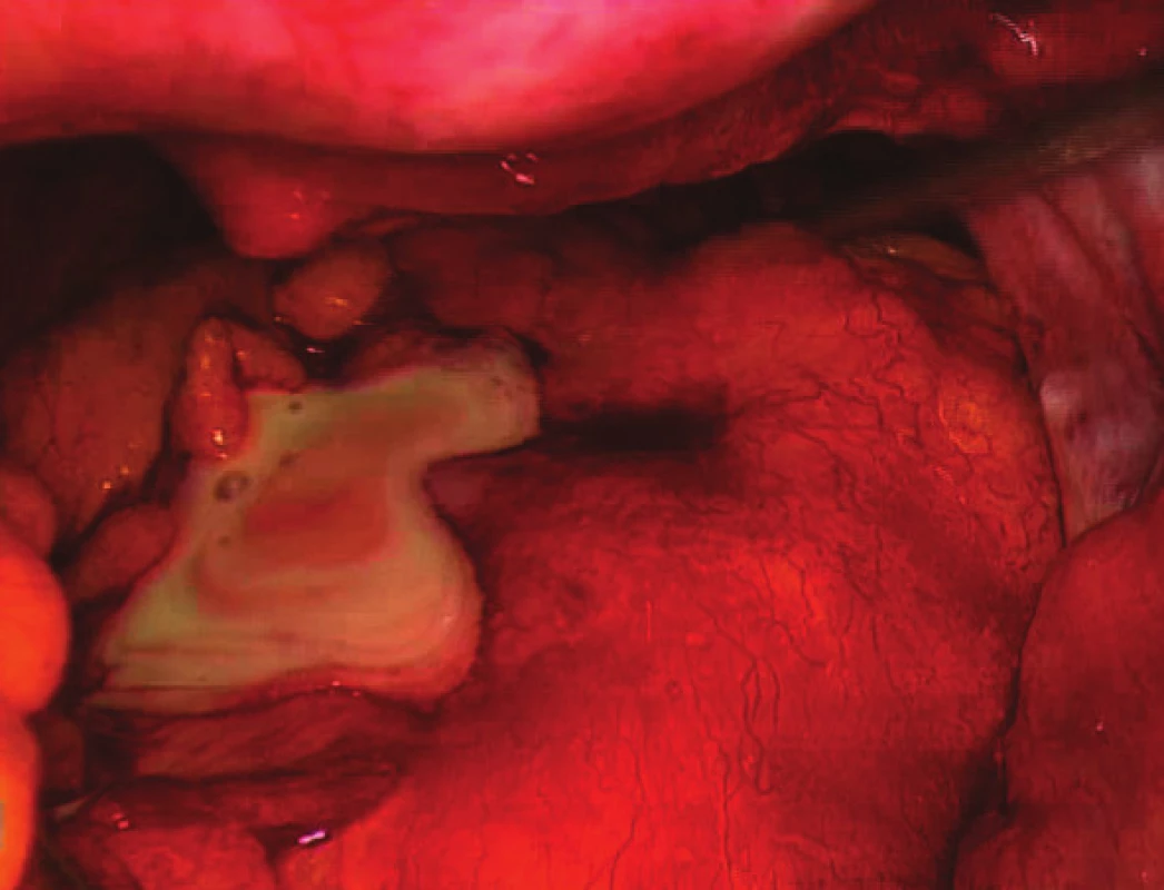 Peroperační nález u pacienta s abscesem v malé pánvi a purulentní peritonitidou
Fig. 1: Peroperative finding in a patient with a pelvic abscess and purulent peritonitis