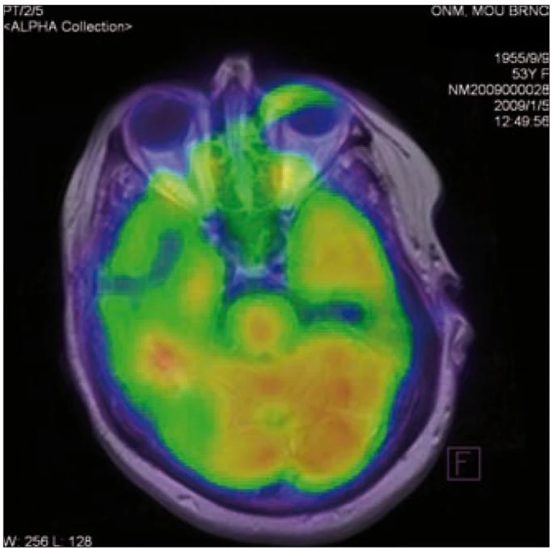 Pozitronová emisní tomografie mozku – solitární ložisko vyšší akumulace radiofarmaka temporálně vpravo, SUV&lt;sub&gt;max&lt;/sub&gt; 12,53 (u pacientky 1).