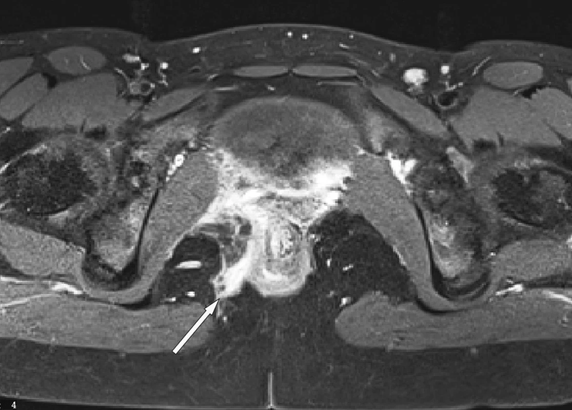 MR – transfinkterická a submukózní perianální píštěl vpravo
Fig. 5. MRI – transphincteric and submucous perianal fistula on the right