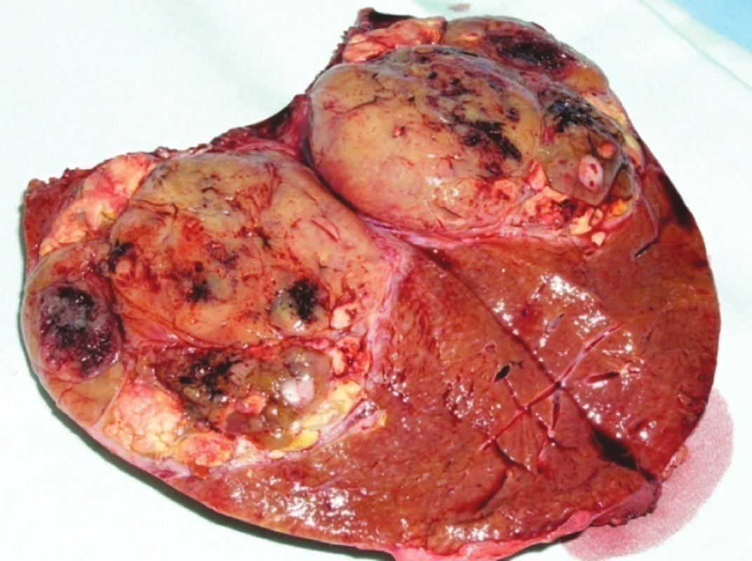 Metastáza renálního karcinomu v pravém laloku jater
Fig. 3. Renal carcinoma metastasis in the right liver lobe