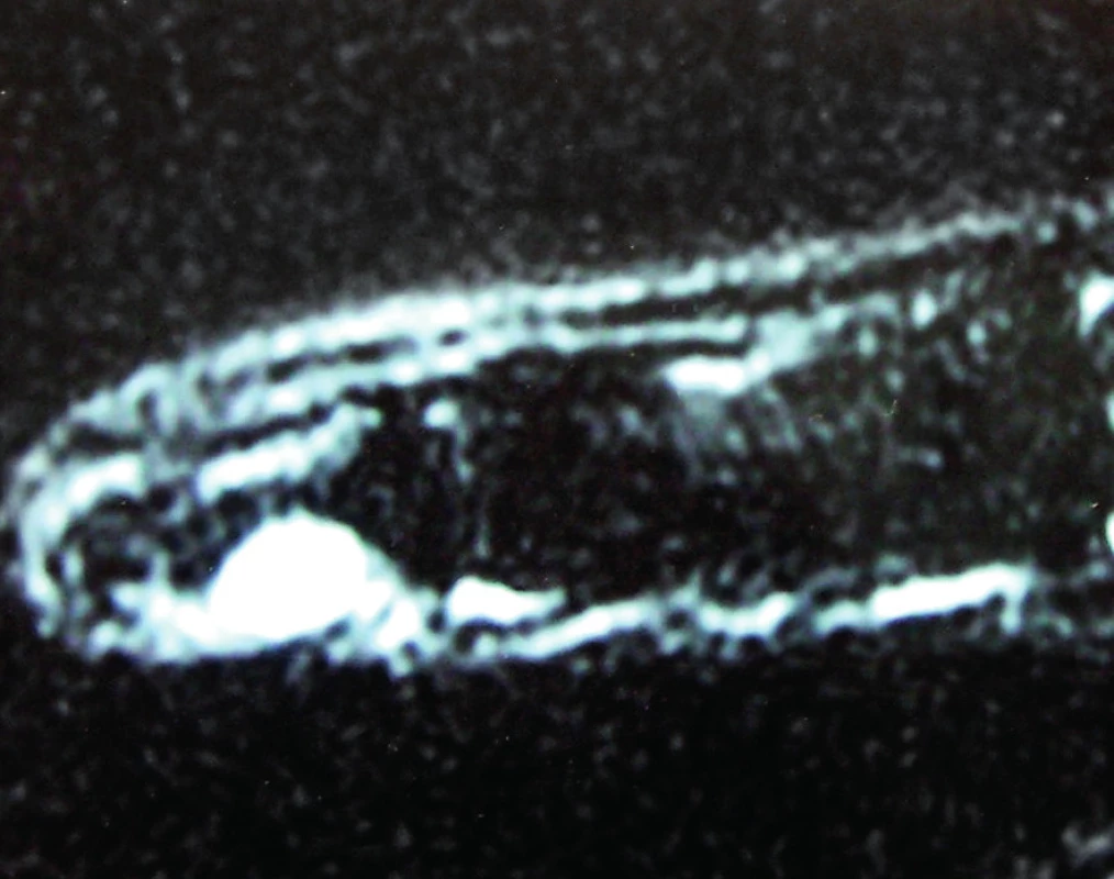 MRI of glomus tumor (a sagittal view)