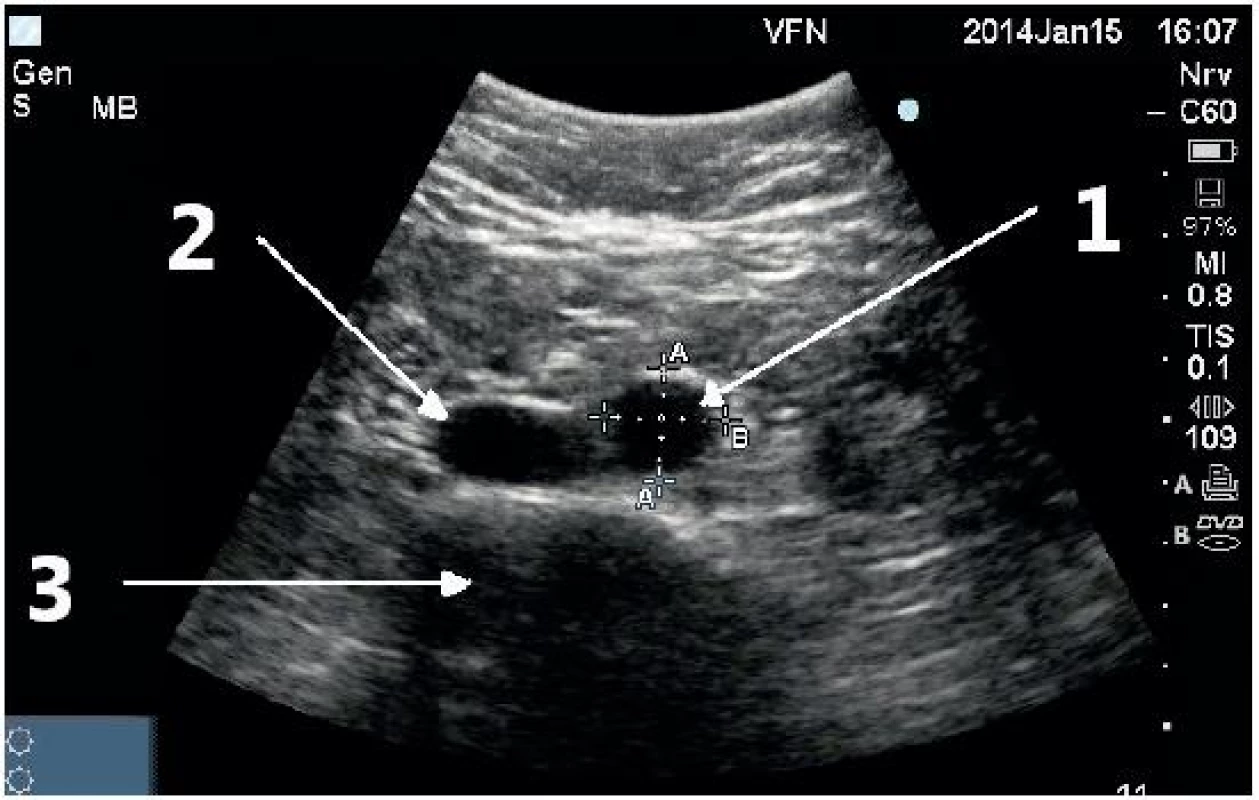 Příčné zobrazení distální břišní aorty s fyziologickými rozměry