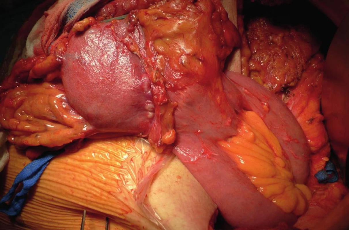 Pahýlový karcinom v oblasti anastomózy 42 let po BII resekci pro benignitu
Fig. 1: Gastric stump cancer 42 years after BII resection for benign disease, located at the anastomotic site