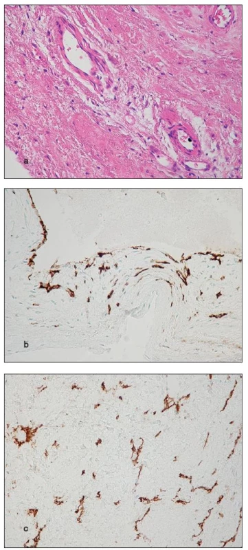a) Thick-walled blood vessels in the base of a cusp (H&amp;E stain); b) Infolding of the endocardium from the valvular surface, possibly giving origin to small vessels (CD31); c) Non-luminized endothelial sprouts and small vessels (CD31)