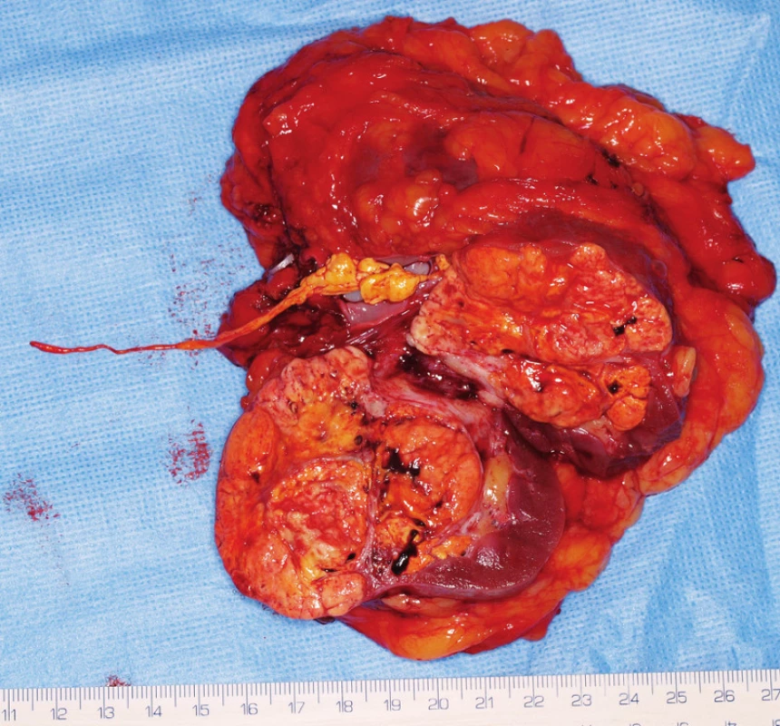 Žena 49 let s tumorem levé ledviny T3a s trombem v renální žíle. 1A – MRI axiální řez, zeleně označen tumor, zelenou šipkou trombus. 1B–D– MRA (B – pohled zepředu, C – zezadu) zobrazuje jednu tepnu (A) a anomální žilní zásobení připomínající „duplexní ovarickou žílu“: do levostranné ledvinné žíly se z kaudální strany vlévá silná žíla (mediální véna – MV), která je rudimentární levostrannou dolní dutou žilou, do ní ústí levostranná ovarická žíla (laterální žíla – LV), a také levostranné lumbální žíly. Rudimentární DDŽ je spojena s v. iliaca communis sin. – tato žíla se však vlévá hlavním tokem do pravostranné normální DDŽ. Při laparoskopii (1e) je dobře patrná „zdvojená ovarická žíla“ a i prosvítající trombus v renální žíle (označen šipkou). Po přerušení renální tepny těsně u aorty pomocí klipů (1F) je patrné, že žilní trombus je rozsáhlejší, byla provedena konverze v otevřený výkon a odstraněn dlouhý tenký trombus zasahující až do DDŽ (1G)
Fig. 1.  49-year-old woman with a tumour of the left kidney T3a with thrombus in the renal vein and anomaly of left ovaric vein. She underwent laparoscopic nephrectomy with open conversion due to advanced thrombus.