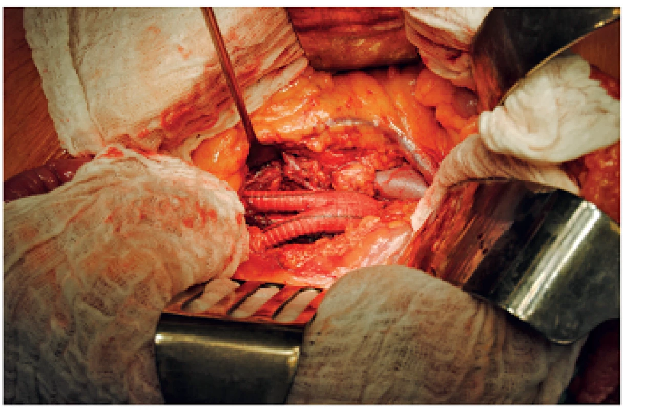 Implantovaná bifurkační cévní protéza do aorto-bifemorální pozice po resekci vaku aneuryzmatu břišní aorty
