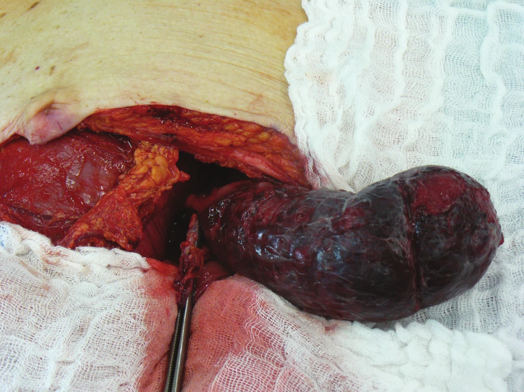 Peroperační nález invaginovaného úseku colon sigmoidei
Fig. 4: Intraoperative finding of the invaginated portion in the sigmoid colon area