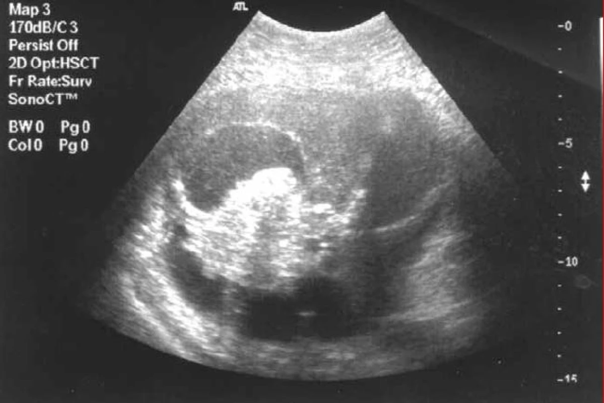 Abdominální ultrazvukový nález nádorové masy ovaria.