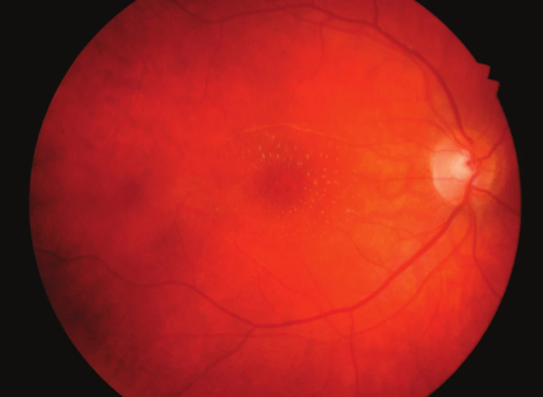 Hvězdicová makulopatie pravého oka měsíc po léčbě