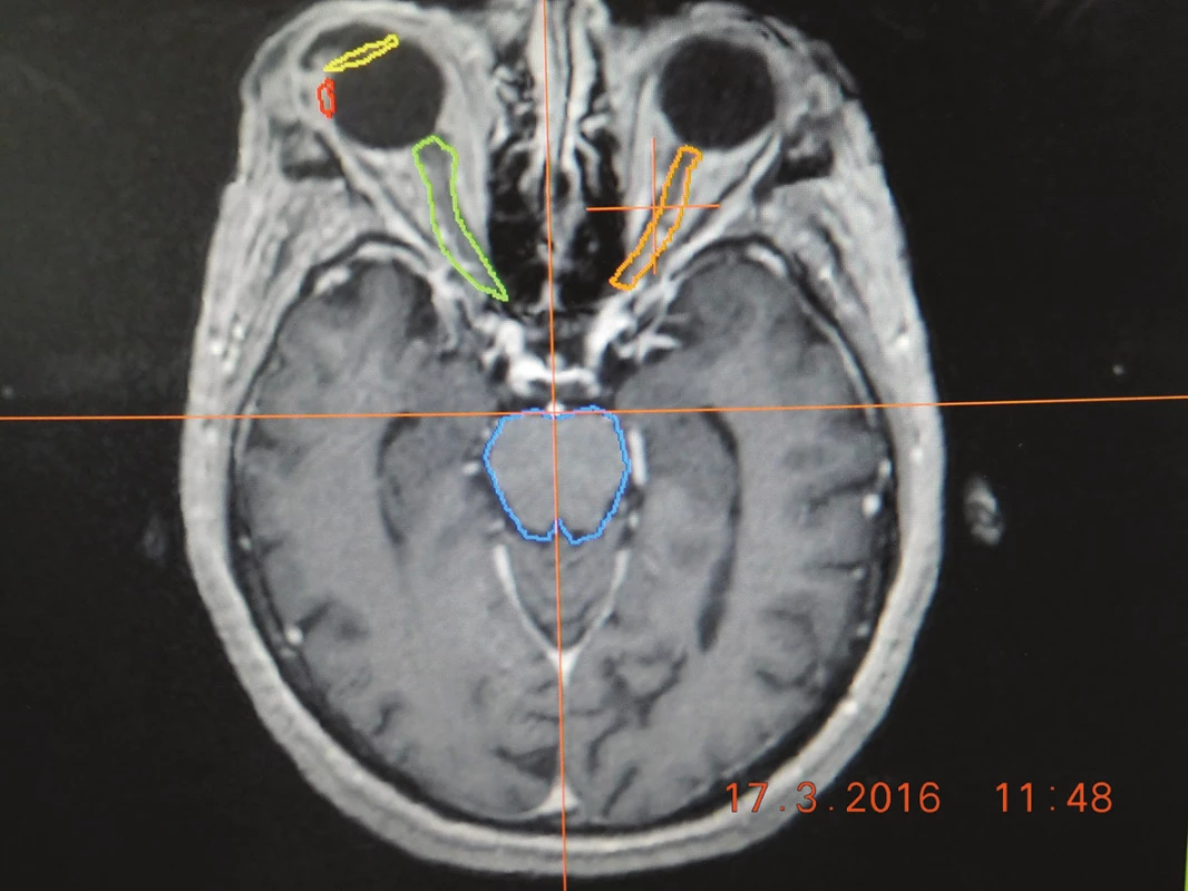 Zameriavacie MRI vyšetrenie pacienta pred stereotaxiou so zakreslením nádorového ložiska (červená farba), a rizikových štruktúr - šošovky (žltá farba), zrakový nerv (zelená 
a oranžová farba), mozgový kmeň (modrá farba)