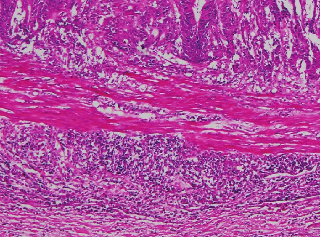 Vpravo od nádoru je souvislý lem lymfocytů, který částečně proniká i do přilehlé hladké svaloviny (HE, původní objektiv 10x).