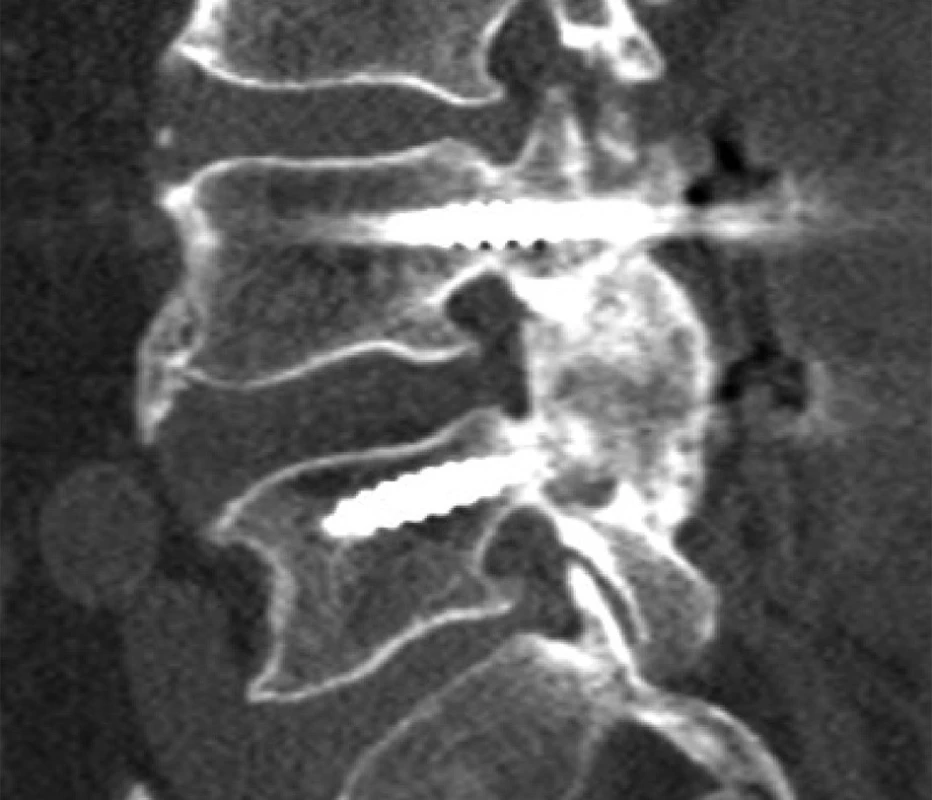 CT LS páteře stejného pacienta Sagitální rekonstrukce v kostním okně na úrovni levého meziobratlového kloubu. Nitrokloubní artrodéza se šrouby zavedenými transpedikulárně a zachováním dostatečně silných kostních můstků na processus articulares L4 a L5.
Fig. 5: CT scan of the same patient Sagital reconstruction in the bone window at the level of the left intervertebral joint. Intrarticular arthrodesis with TP screws and with preservationof the bone bridges of articular processes L4 and L5 vertebrae.