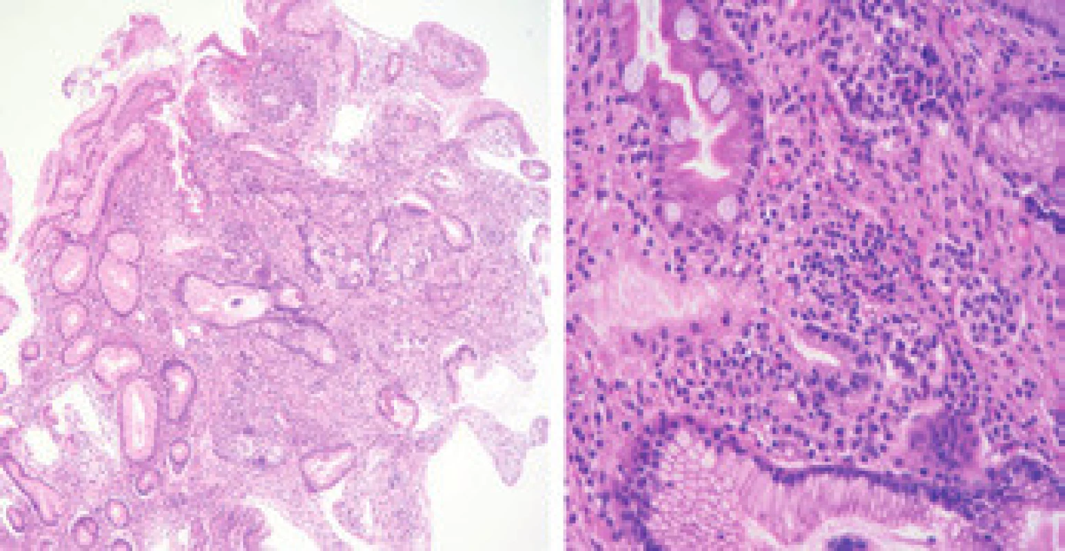 Histologické vyšetření bioptických vzorků – tělo žaludku plochá sliznice.