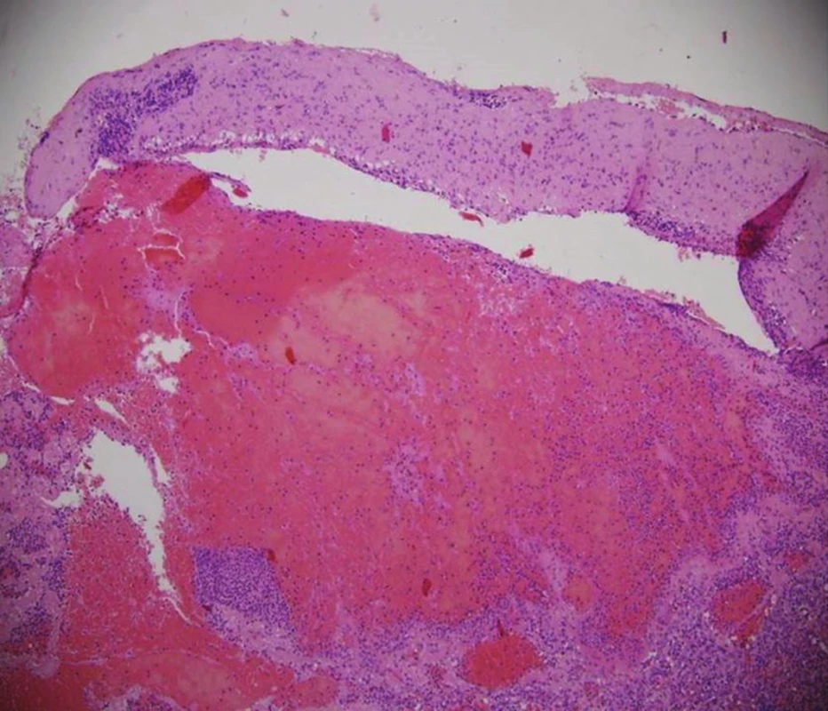 Histologický obraz lacerace sleziny s hematomem