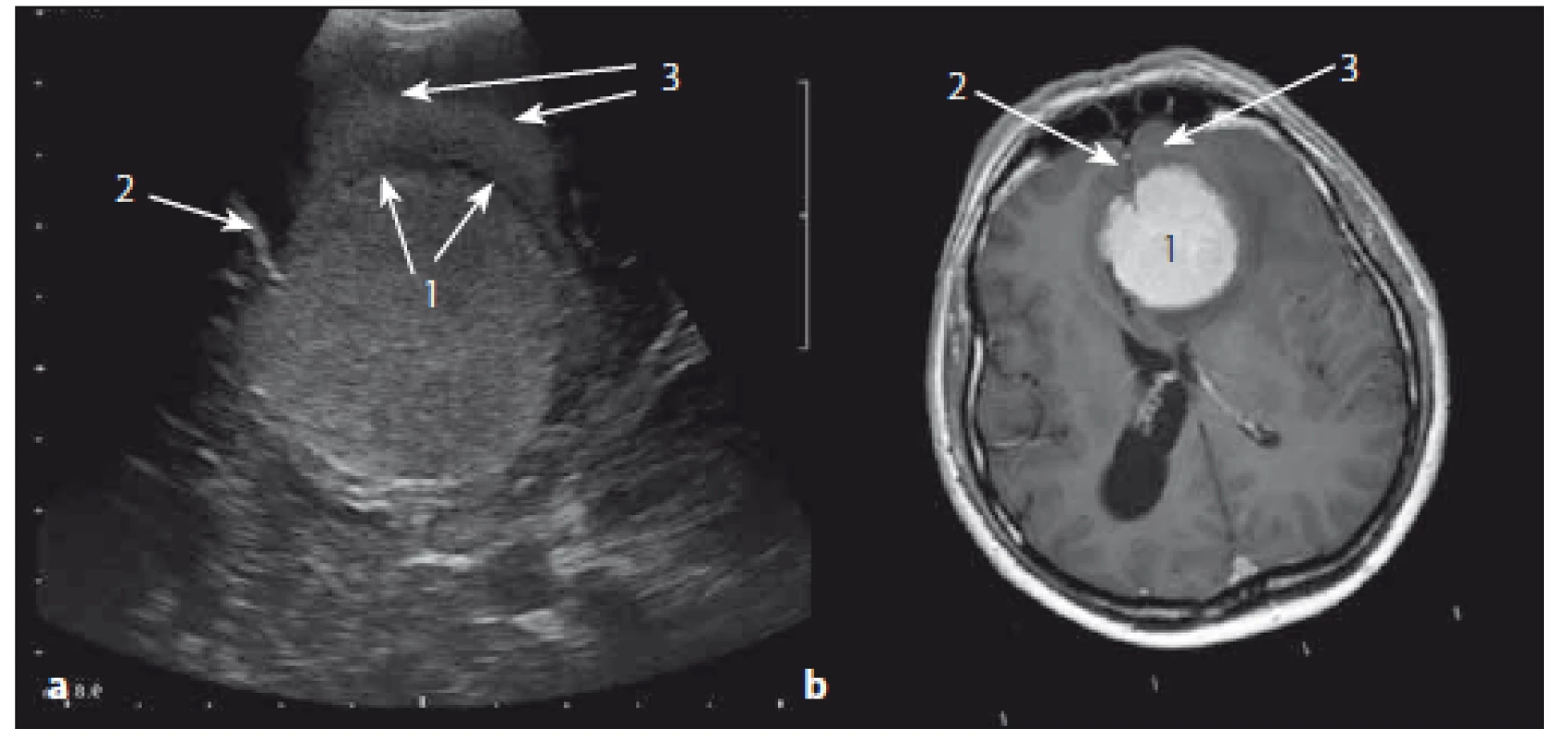 Meningeom čichové rýhy – srovnání axiálních sonografických a MR T1W obrazů.
Fig. 12. Olfactory meningeoma – comparison of axial ultrasound and MRI T1W images.